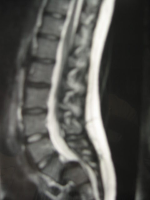 Le Spondylolisthesis Docteur Pierre Moreno Chirurgien Du Rachis