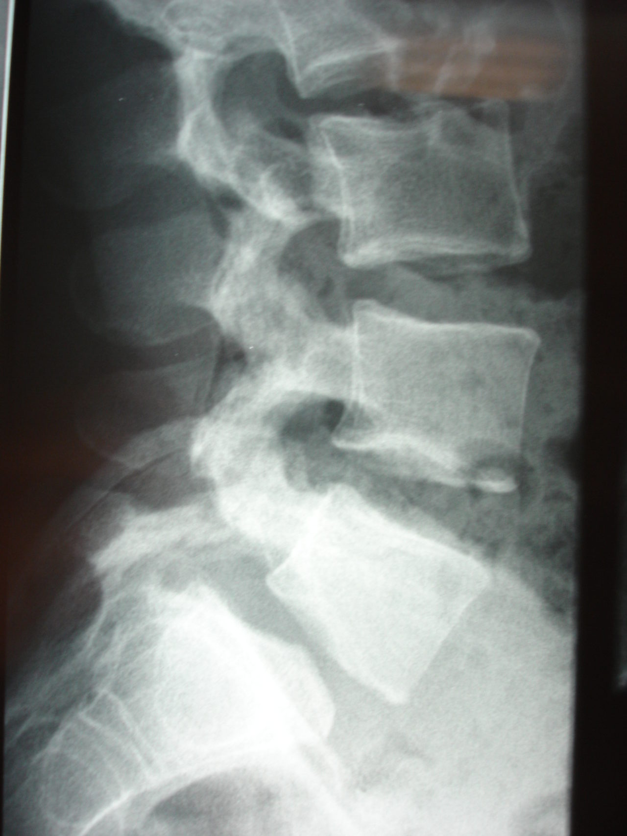 Le Spondylolisthesis Docteur Pierre Moreno Chirurgien Du Rachis